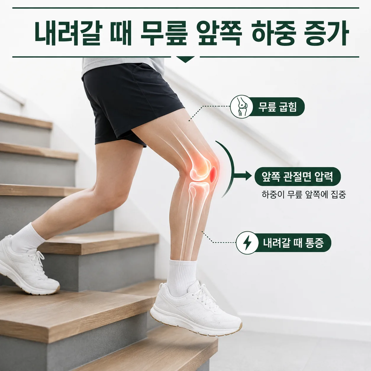 계단을 내려갈 때 무릎 앞쪽 관절면에 하중이 실리는 구간을 표시한 도식