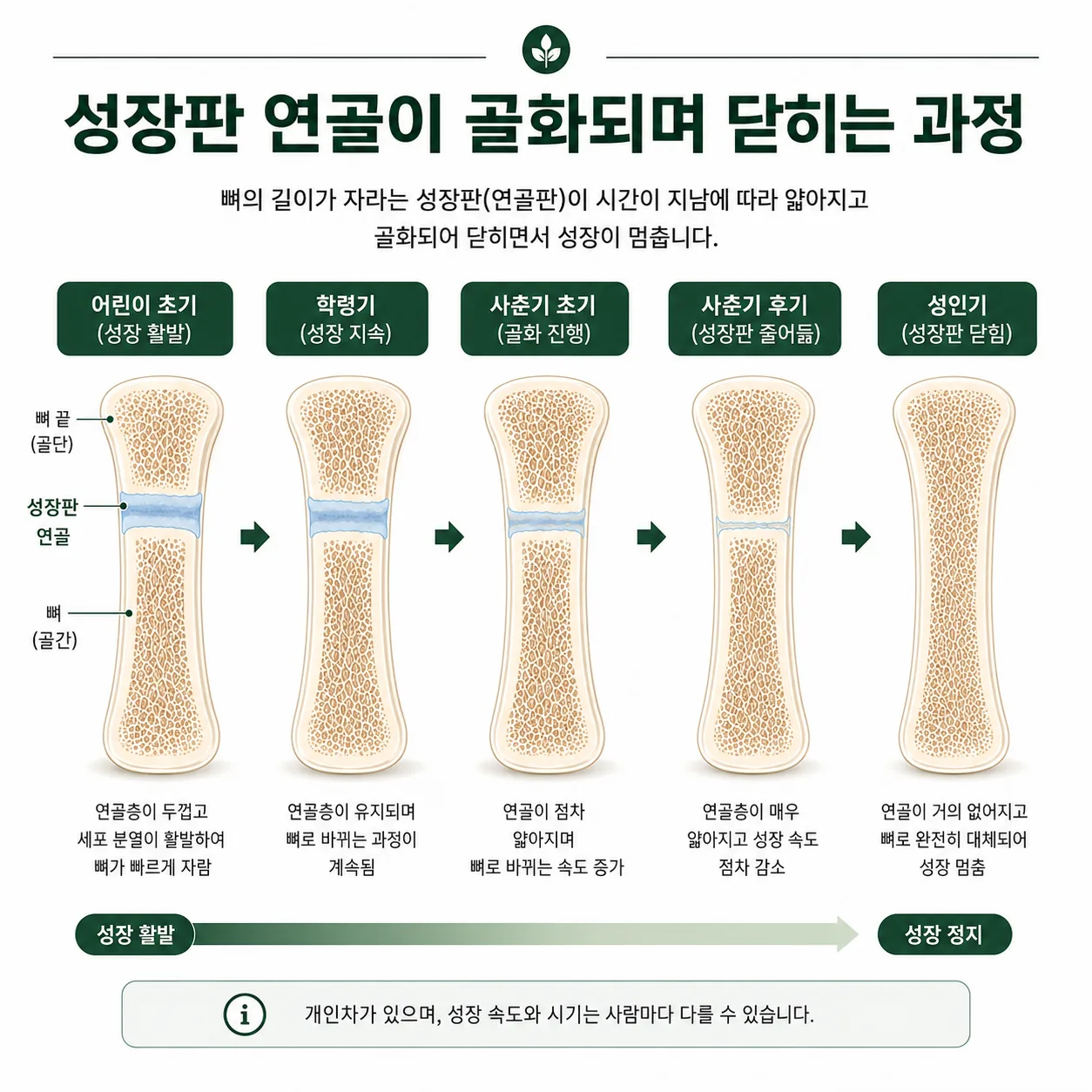 성장판 연골이 골화되며 닫히는 과정을 단계별로 보여주는 그림